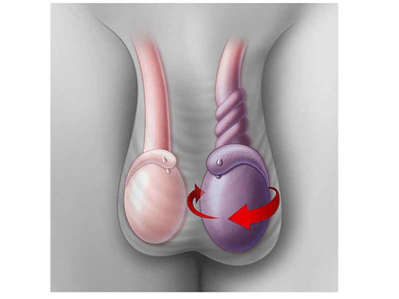 Xoắn tinh hoàn là hiện tượng tinh hoàn tự xoay quanh trục gây tắc nghẽn thừng tinh