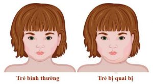 Bạn có thể nhận biết bệnh quai bị qua các biểu hiện sốt cao, mệt mỏi, chán ăn, đau mỏi toàn thân
