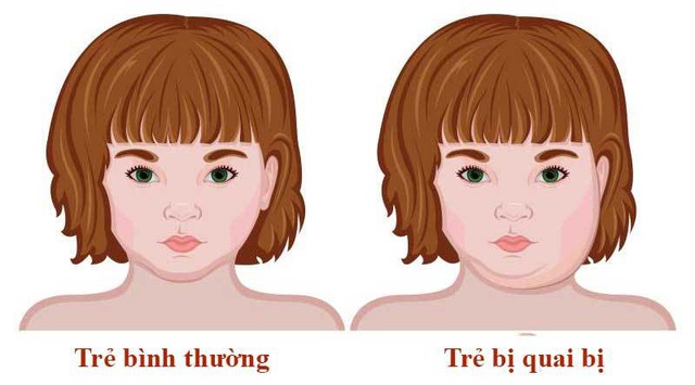 Bạn có thể nhận biết bệnh quai bị qua các biểu hiện sốt cao, mệt mỏi, chán ăn, đau mỏi toàn thân