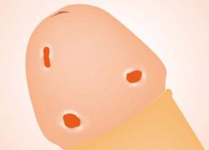 Quan hệ tình dục với quá nhiều người tăng nguy cơ mắc mụn cóc sinh dục