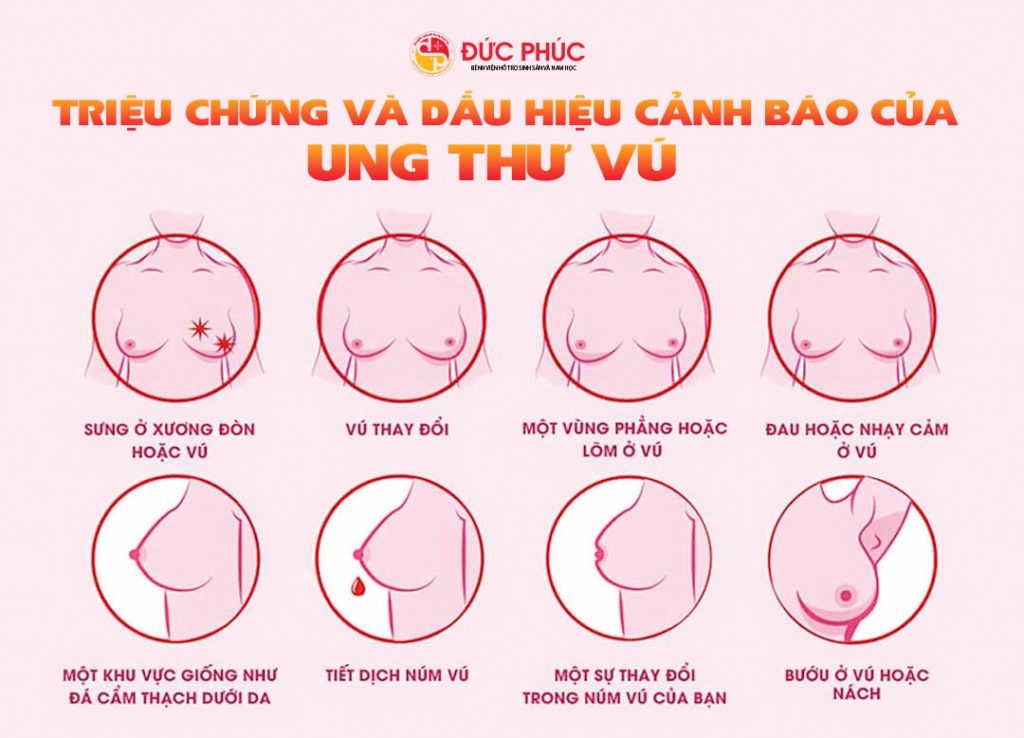 6 triệu chứng ung thư vú