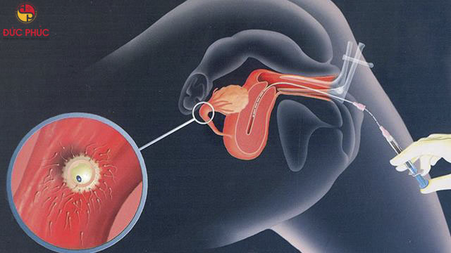 Cẩm nang kinh nghiệm bơm iui thành công 1