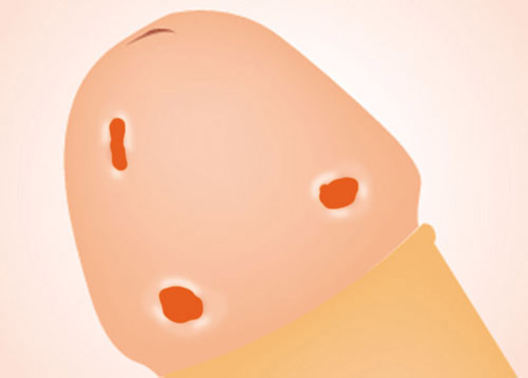 Quan hệ tình dục với quá nhiều người tăng nguy cơ mắc mụn cóc sinh dục