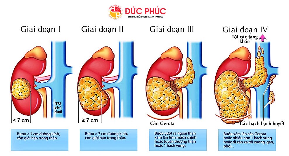 Những thông tin về ung thư mà bạn cần biết