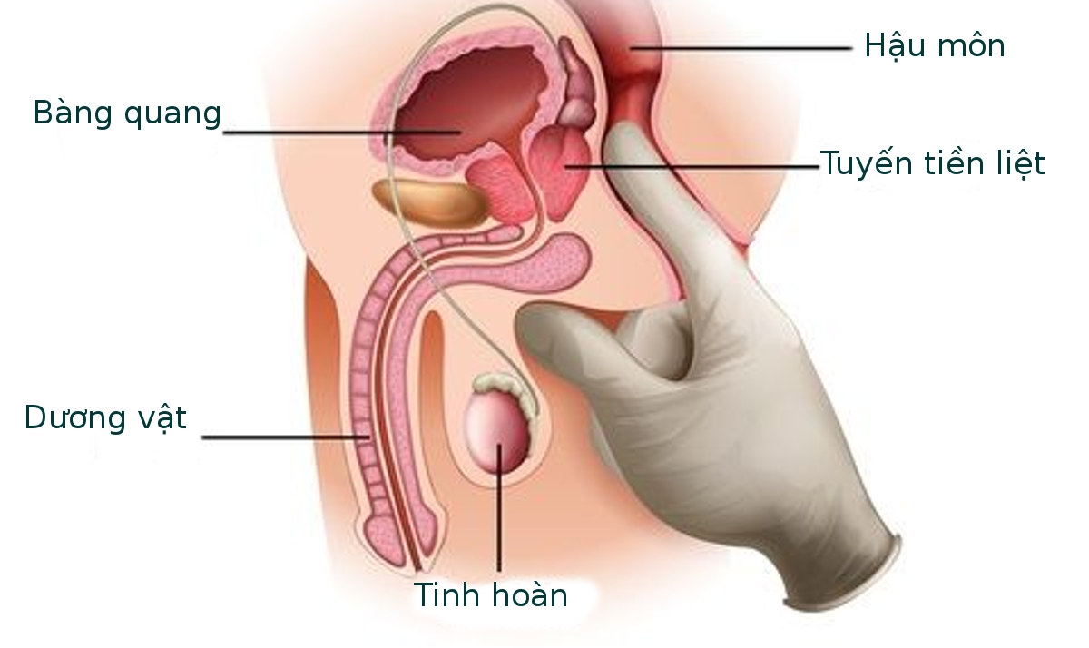Ung thư tuyến tiền liệt gây ảnh hưởng nghiêm trọng đến chức năng tình dục và sức khỏe sinh sản của người đàn ông