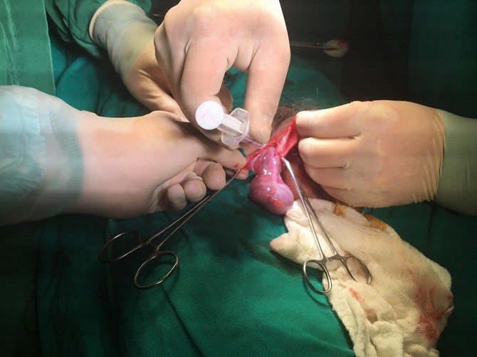 Khi thấy hiện tượng bìu, ống bẹn sưng to, phù nề thì bệnh nhân nên đến cơ sở y tế gần nhất để thăm khám