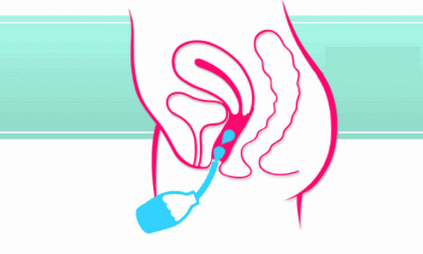 Thụt rửa âm đạo khiến vùng kín bị viêm nhiễm nặng