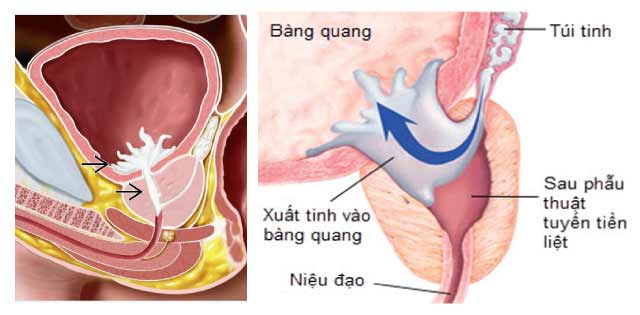 Điều trị vô sinh IUI