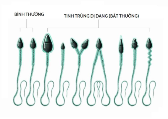 Mô phỏng những hình thái bất thường của tinh trùng 