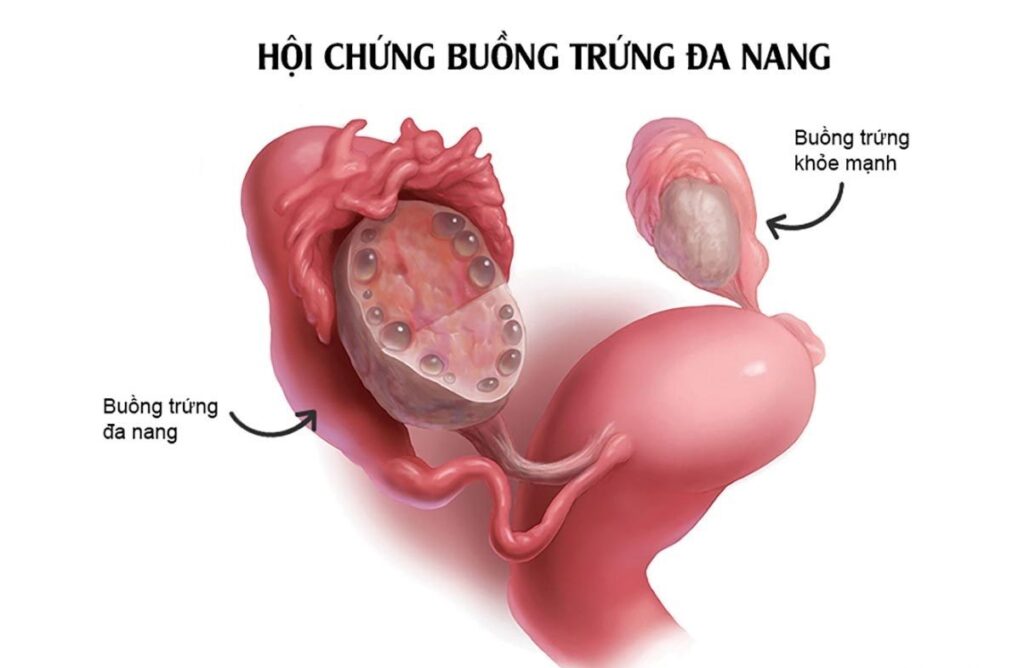 Hội chứng buồng trứng đa nang 