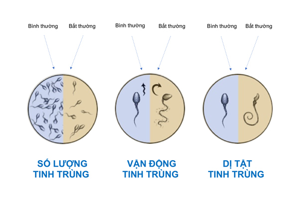 Sự bất thường của tinh trùng