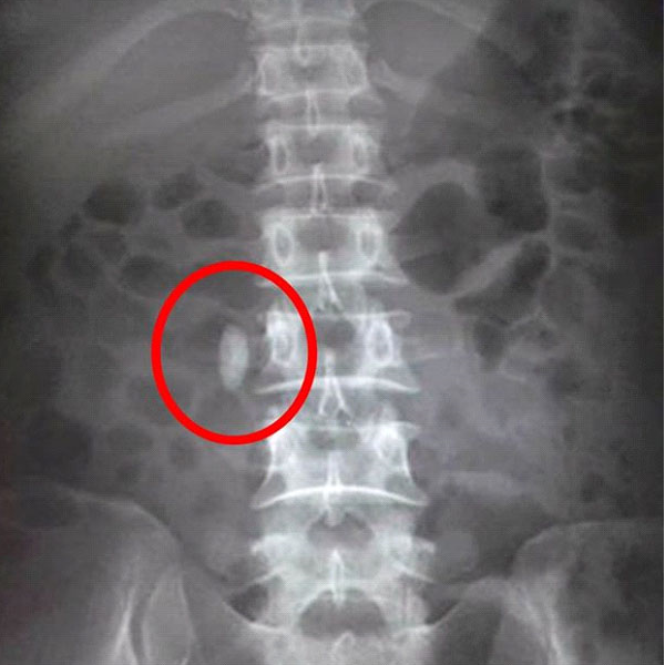 Hình ảnh sỏi niệu quản trên phim KUB 