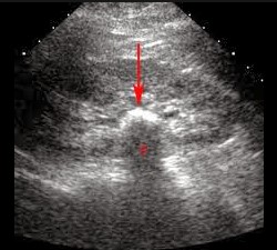 Hình ảnh sỏi thận được phát hiện qua siêu âm (mũi tên đỏ) 