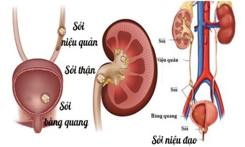 Phân loại sỏi tiết niệu