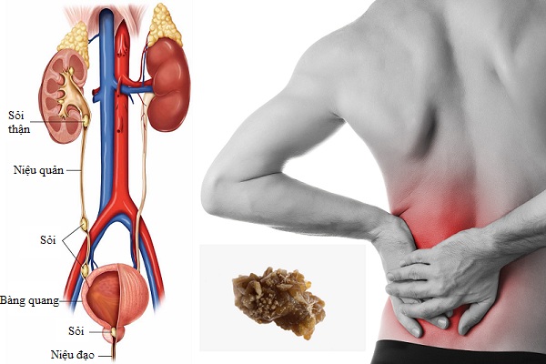 Sỏi thận là bệnh lý thường gặp ở nam giới độ tuổi trung niên 