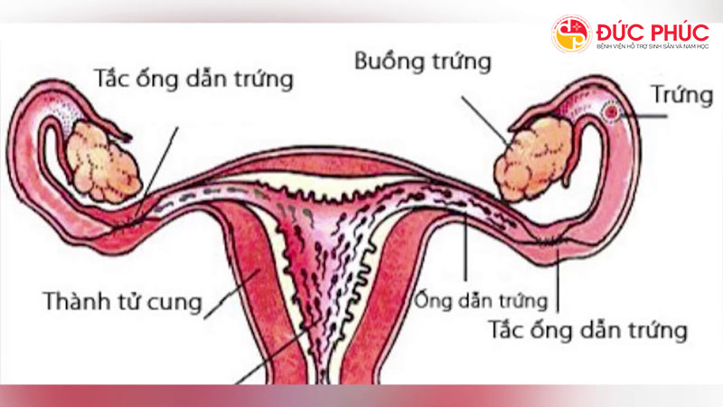 Điều trị tắc vòi trứng