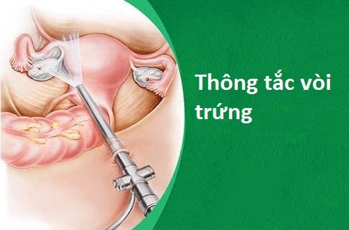 Điều trị tắc vòi trứng