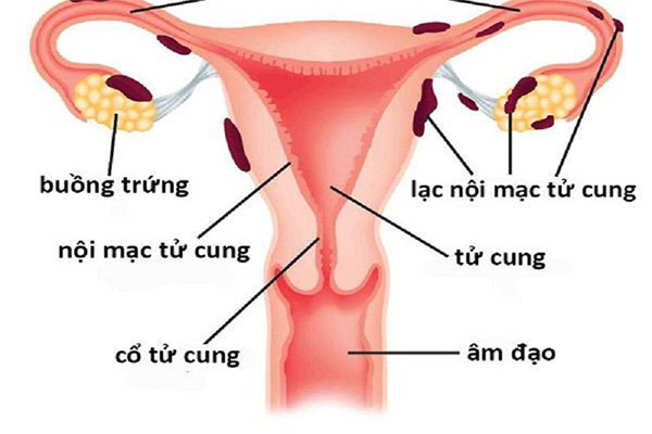 Điều trị tắc vòi trứng
