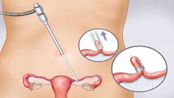 Điều trị tắc vòi trứng