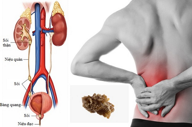 Cơn đau quặn thận là triệu chứng điển hình trong bệnh sỏi niệu quản 