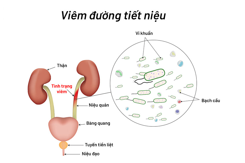Sự di chuyển của sỏi làm tổn thương niêm mạc niệu quản tạo điều kiện thuận lợi cho vi khuẩn phát triển 