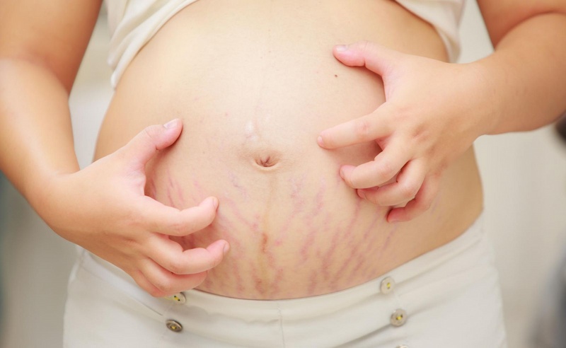 Bị ngứa khi mang thai có thể do thay đổi hormone hoặc bệnh lý gây ra