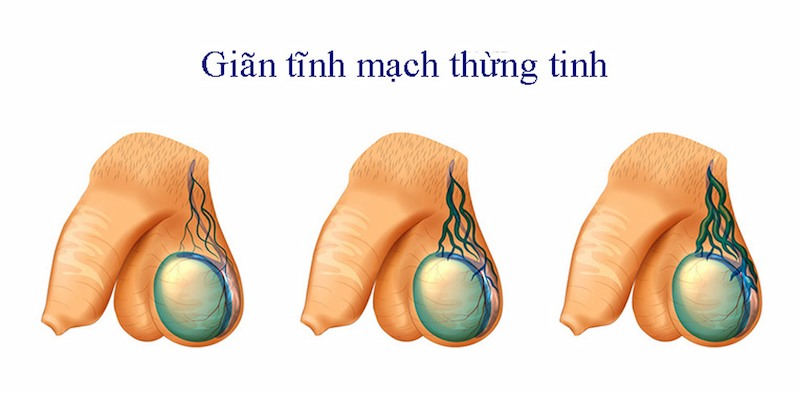 Bệnh lý được chia thành nhiều cấp độ khác nhau