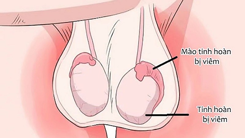 Tinh hoàn bình thường và khi bị viêm