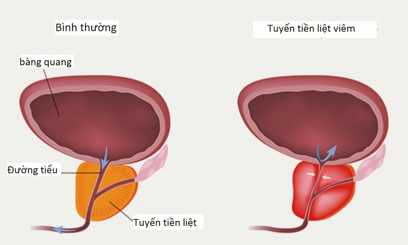 Hình ảnh tuyến tiền liệt bình thường và khi bị viêm