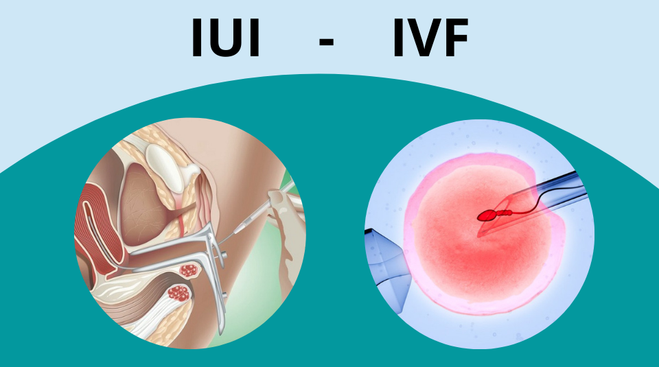 IUI và IVF là hai phương pháp điều trị vô sinh hiếm muộn phổ biến nhất hiện nay ( Ảnh internet )