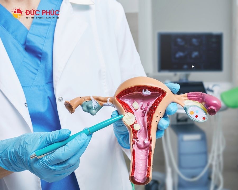 U xơ tử cung là một trong những vấn đề sinh sản được chỉ định làm thụ tinh ống nghiệm