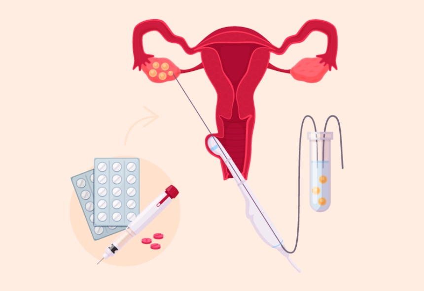 Bước đầu tiên trong quy trình IVF là tiến hành kích trứng.