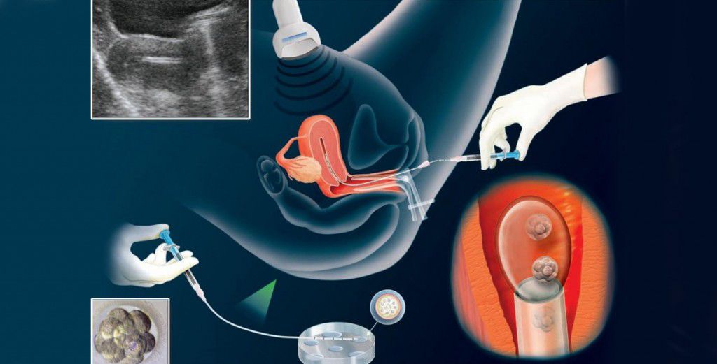 Bước “quyết định” trong quy trình thụ tinh ống nghiệm là chuyển phôi