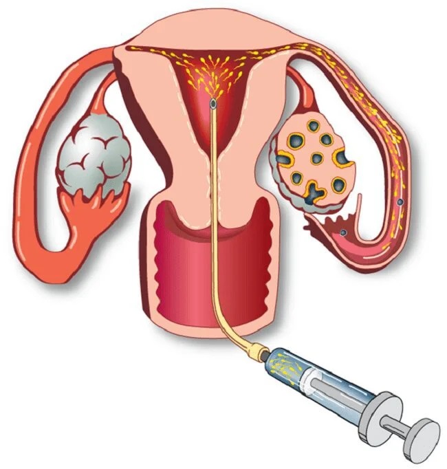 IUI là kĩ thuật bơm trực tiếp tinh trùng đã lọc rửa vào buồng tử cung