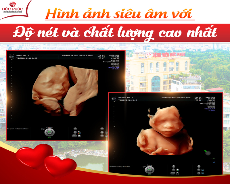 Siêu âm thai nhi được xem là phương pháp tính tuổi thai IVF một cách chính xác nhất