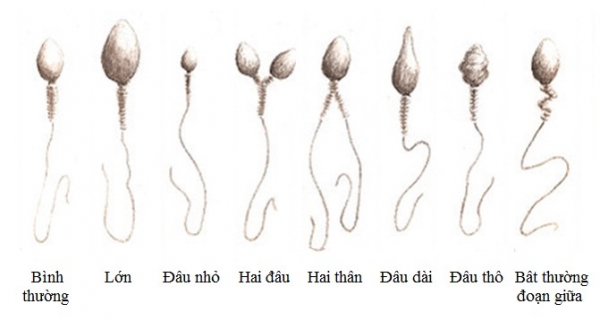 Tinh trùng dị dạng có đầu kỳ lạ, có thêm đầu hoặc đuôi