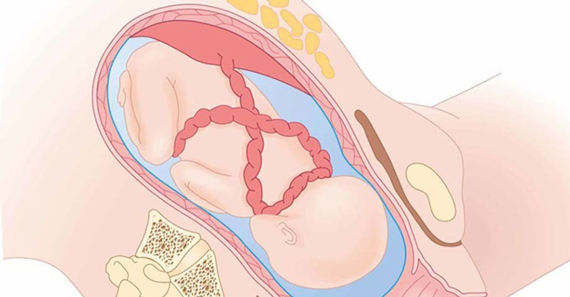 Dây rốn bị sa, thắt nút hoặc xoắn có thể cản trở việc vận chuyển oxy gây suy thai