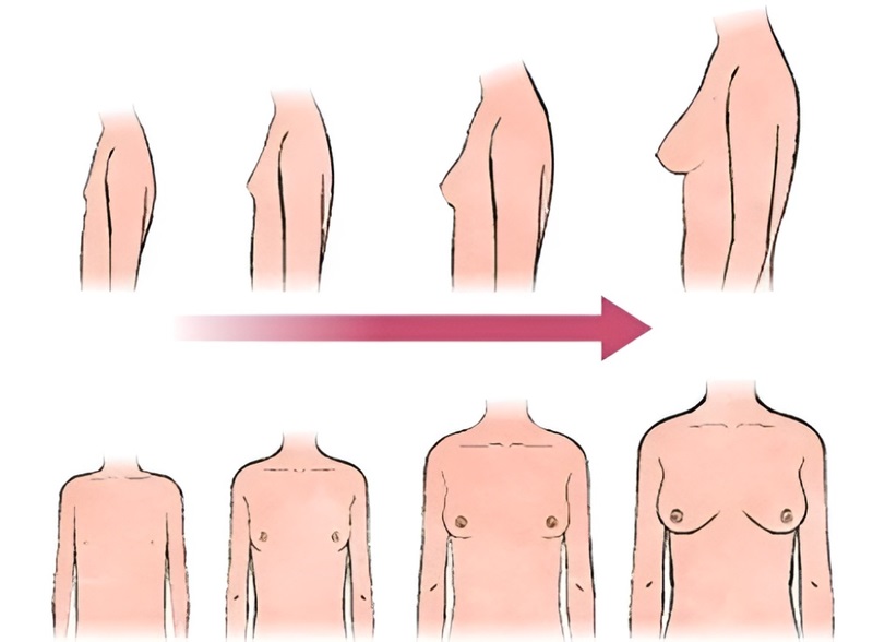 Khuôn ngực không phát triển như bình thường do sự thiếu hụt nội tiết tố estrogen 