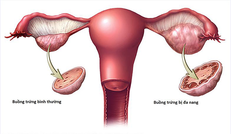 Hội chứng buồng trứng đa nang (PCOS) là một vấn đề sức khỏe phổ biến ở phụ nữ