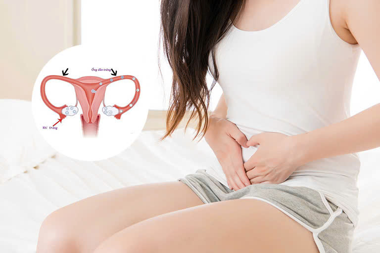 Viêm ống dẫn trứng là một bệnh lý thuộc nhóm bệnh viêm vùng chậu