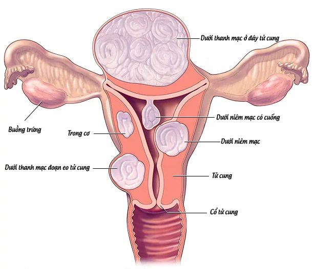 Trong số 18 phụ nữ thì có khoảng 1 người gặp phải những bất thường ở tử cung