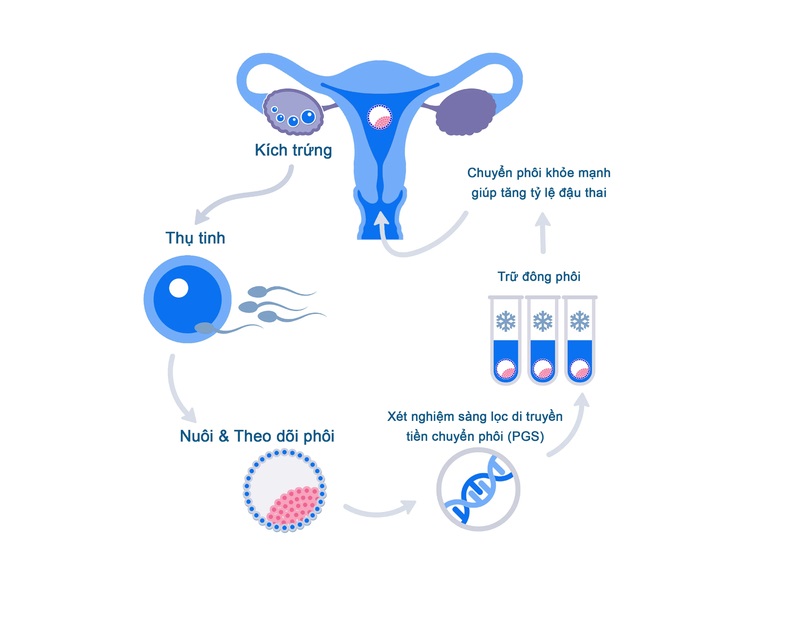 Chuyển phôi là một phần trong quy trình IVF