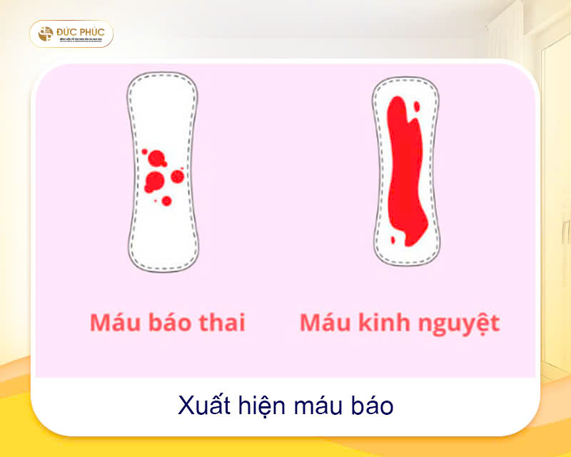 Một trong những dấu hiệu thành công sau khi chuyển phôi IVF  là sự xuất hiện của máu báo