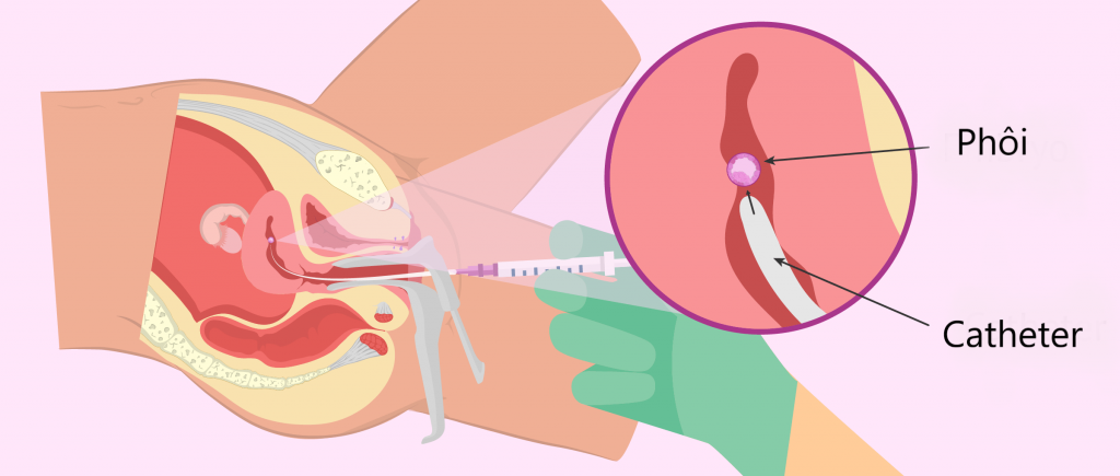 Thủ thuật chuyển phôi diễn ra khá nhanh và không gây đau đớn