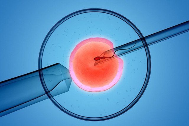 IVF cho người suy giảm buồng trứng cần kỹ thuật cao